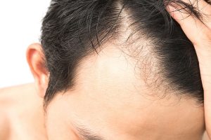 در مورد کاشت مو چه می دانید؟